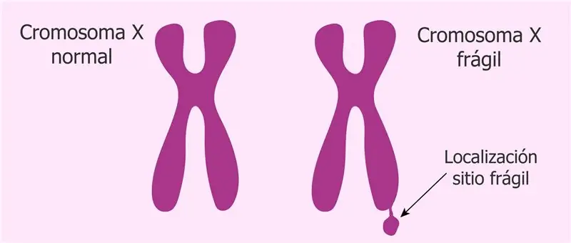 Результат изображения для синдрома ломкой Х-хромосомы