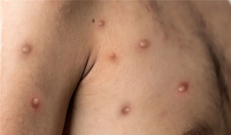 Трагическая история молодого человека, заболевшего обезьяньей оспой: «Я впал в депрессию, не знал, что делать»