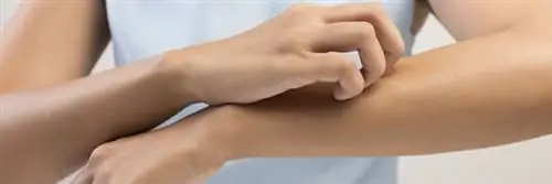 Зуд: 5 советов против укусов комаров