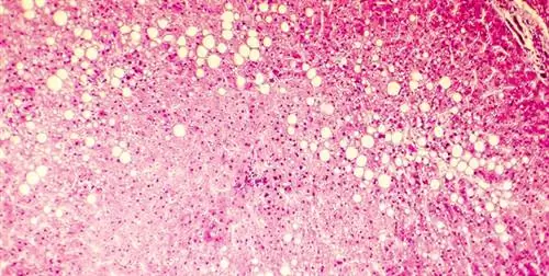 жировая болезнь печени