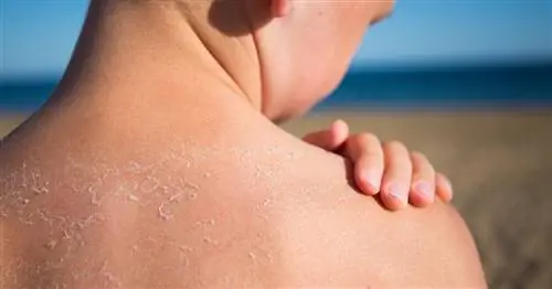 Солнечные ожоги у детей: опасность, о которой пока мало известно