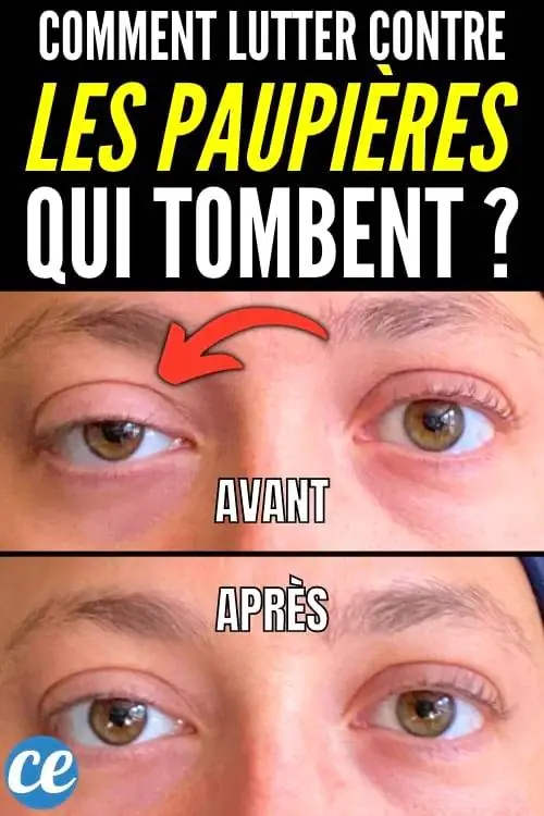 Как подтянуть мышцу века?