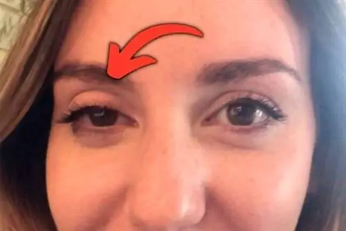 Опущение век вызвано расслаблением мышцы, поднимающей веки.