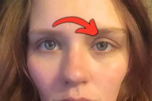 Опущенные веки могут поражать один или оба глаза.