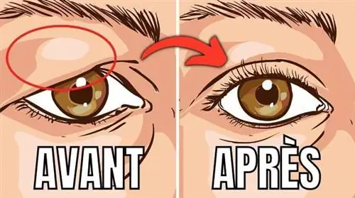 5 натуральных средств от обвисших век