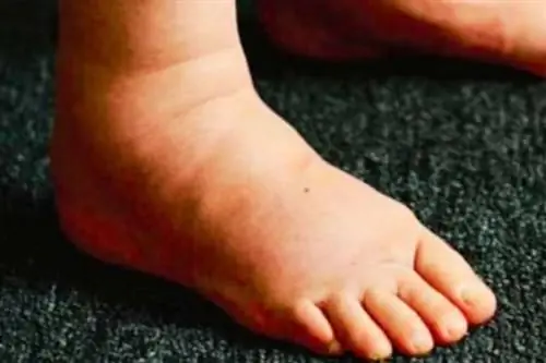 Опухшая нога из-за задержки воды