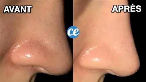 Нос женщины слева полон черных точек и чистая кожа благодаря пищевой соде