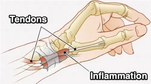 10 упражнений для быстрого лечения теносиновита Кервена