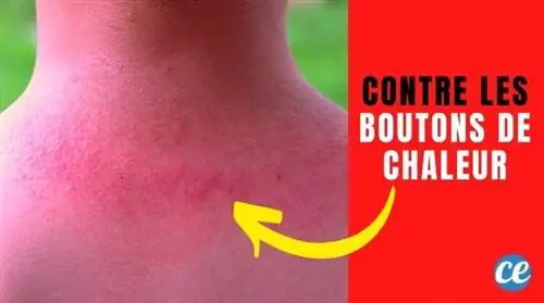 8 средств, которые помогут избавиться от потницы