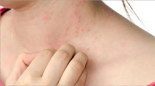 Волшебное средство для естественного избавления от экземы