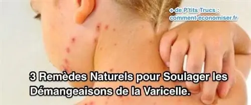 средства от ветрянки без лекарств