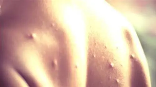 Ветряная оспа: 3 натуральных средства для быстрого облегчения зуда