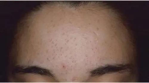 Эффективное средство для естественного избавления от черных точек