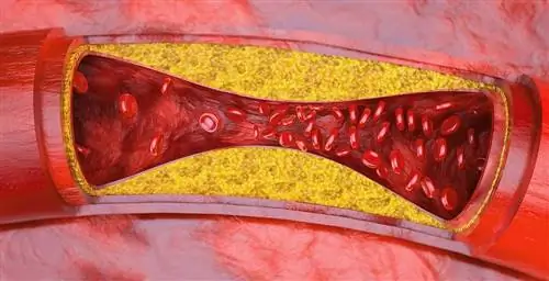 С фрагментами РНК против атеросклероза?