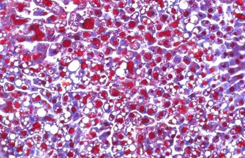 Кортизон: раскрыта тайна о побочном эффекте