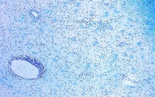 Кишечная флора как триггер рассеянного склероза