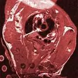 МРТ позволяет увидеть уплотнение артерий