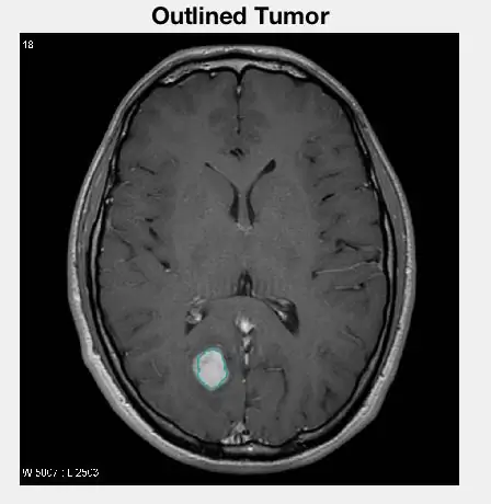 Выделение опухоли