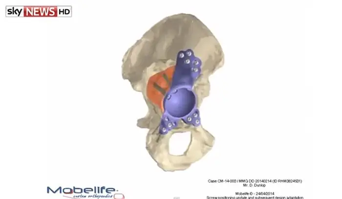 CAD-модель mobilelife для замены тазобедренного сустава, напечатанная на 3D-принтере CAD-модель mobilelife для замены тазобедренного сустава, напечатанная на 3D-принтере