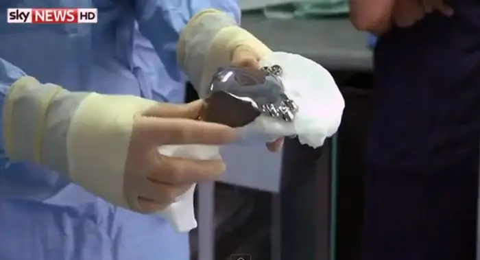 Замена тазобедренного сустава на 3D-принтере Замена тазобедренного сустава на 3D-принтере