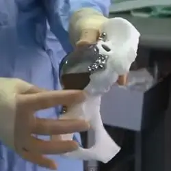 3D-печать замены тазобедренного сустава стволовыми клетками