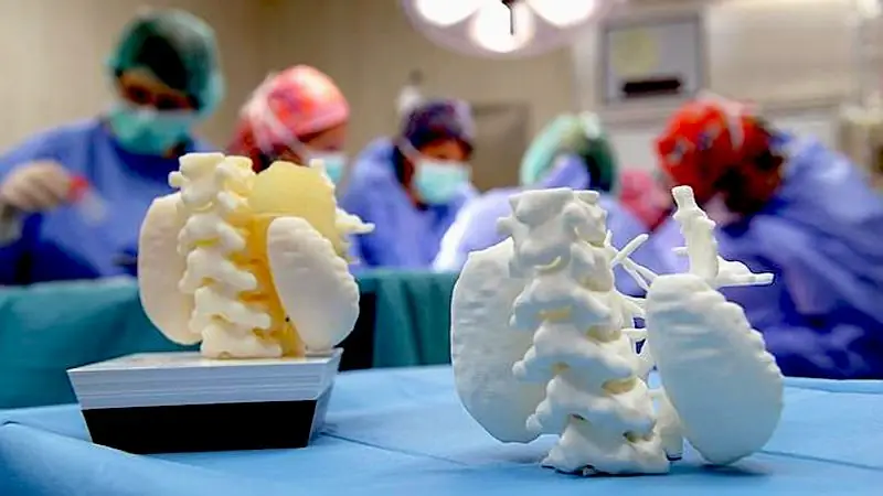 Распечатанная на 3D-принтере модель опухоли для 5-летнего Марка Распечатанная на 3D-принтере модель опухоли для 5-летнего Марка