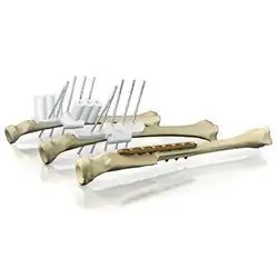 Восстановление костей с помощью 3D-печатных имплантатов