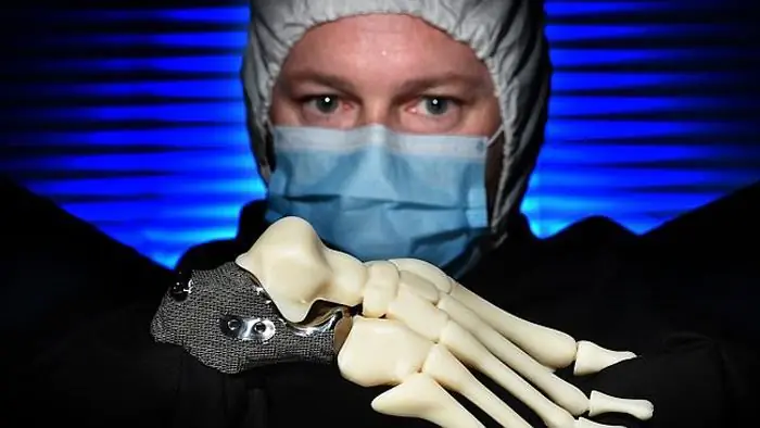 3D-печать пяточной кости для Лена Чендлера 3D-печать пяточной кости для Лена Чендлера