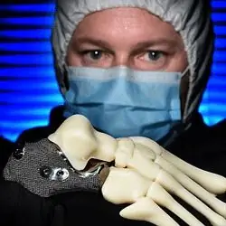 3DP Пяточная кость предотвращает ампутацию