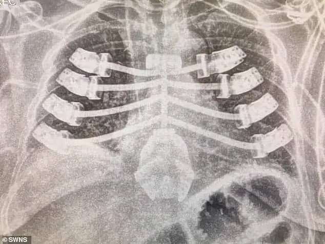 Напечатанный на 3D-принтере имплантат грудины из титана.