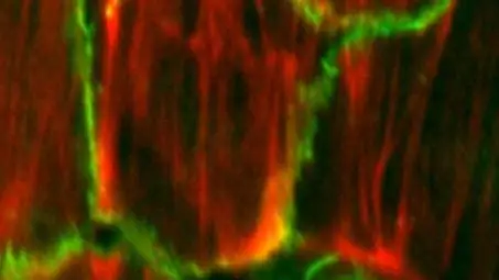 Артериосклероз: губительный штамм