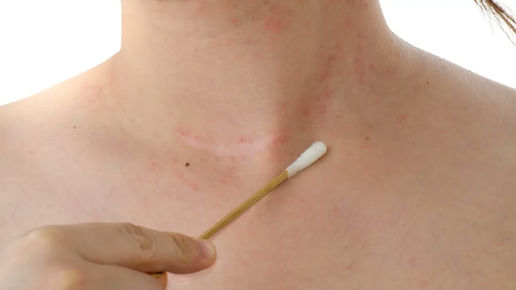 Атопическая экзема: здоровая кожная флора защищает от нейродермита