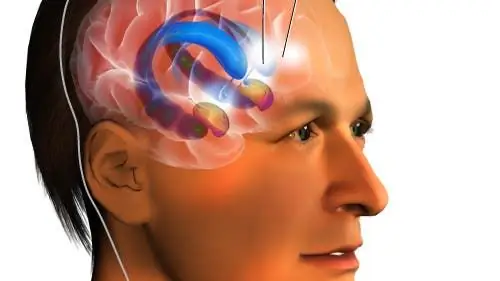 Психиатрия: глубокая стимуляция мозга обещает лечение обсессивно-компульсивного расстройства