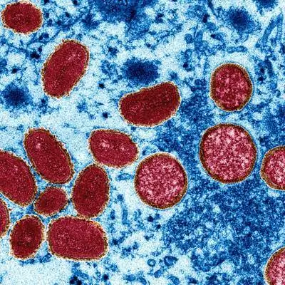 Заболеваемость обезьяньей оспой растет - вот что нам известно на данный момент