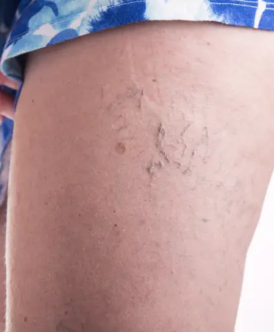 Новые рекомендации по холестерину рекомендуют дополнительное лечение