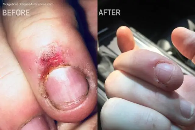 Альтернативные методы лечения: иглоукалывание помогает при головных болях напряжения