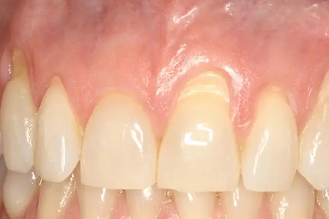 Новая хирургическая техника защищает от слепоты