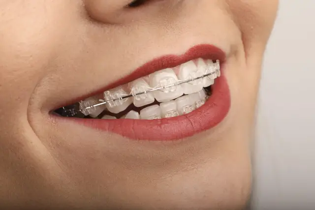 Девочки чаще хотят носить брекеты, чем мальчики